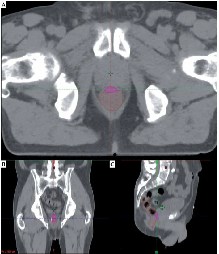 Fig. 2. The most exposed 2 cm 3  part (pink) of rectum (brown) in axial (A), in coronal (B), and in sagittal (C) slice of the TT CT