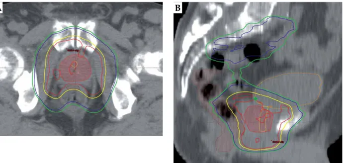 Fig. 4. The most exposed 2 cm 3  of rectum is indicated with brown, the urethra and the bladder are contoured with yellow and  orange, and the prostate gland is shown with red (color wash) in axial (A) and sagittal (B) CT slice in two-step  intensity-mod-u