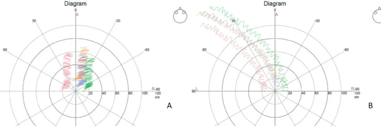 3. ábra: A Fukuda teszt során kapott normál és balra deviáló vizsgálati személyek mérési rajzolata. 