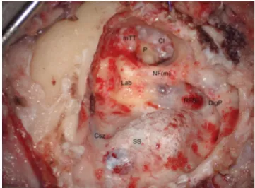 1. ábra Subtotalis petrosectomia műtéti ürege a csontmunka befejezését  követően (jobb oldal)