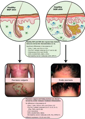 Fig. 1. Although the immune and barrier characteristics of healthy  sebaceous gland poor (SGP) and sebaceous gland rich (SGR) skin are  different, the psoriatic plaques developing on these distinct areas  bear similar cellular, molecular and barrier charac