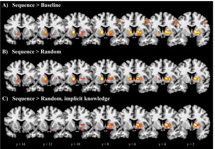Figure 3. Neural correlates of sequence learning: clusters in the basal ganglia (coronal  views)