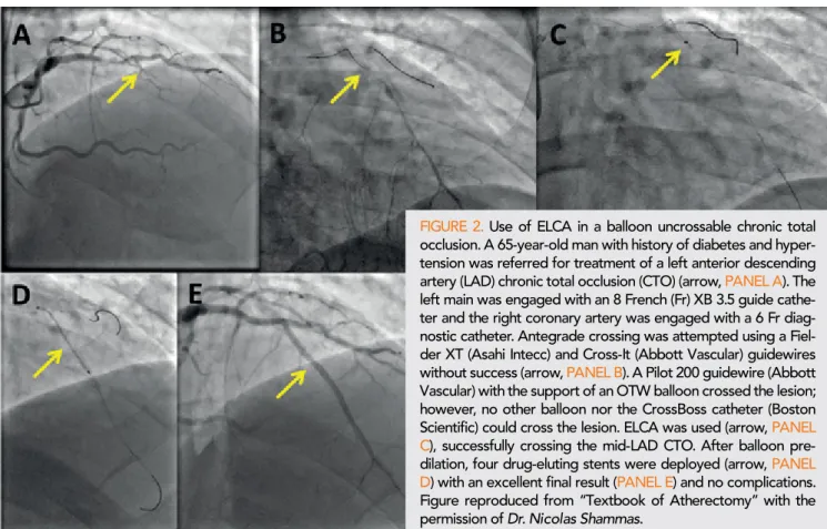 FIGURE 2. Use of ELCA in a balloon uncrossable chronic total  occlusion. A 65-year-old man with history of diabetes and  hyper-tension was referred for treatment of a left anterior descending  artery (LAD) chronic total occlusion (CTO) (arrow, PANEL A)