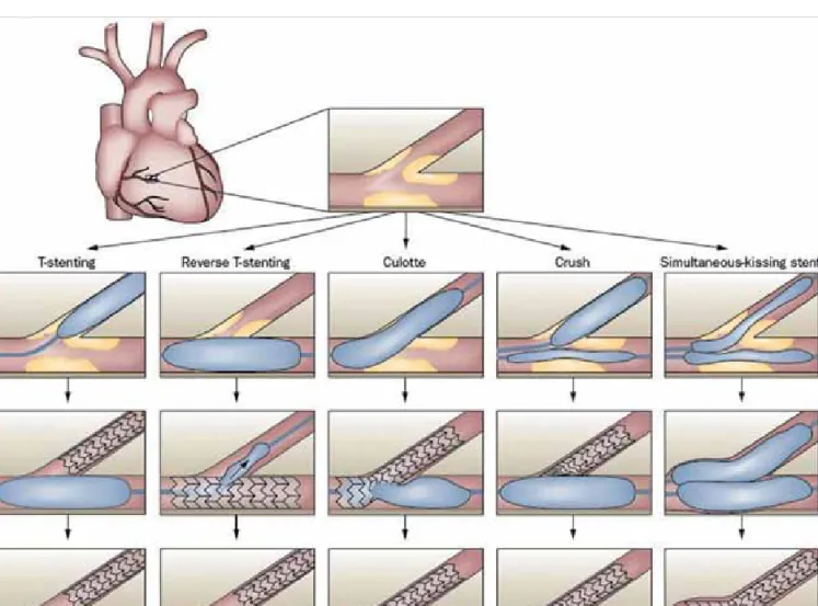 4. ÁBRA. A tervezetten két stentes stratégiák vázlata (http://www.medscape.org/viewarticle/727014_2)