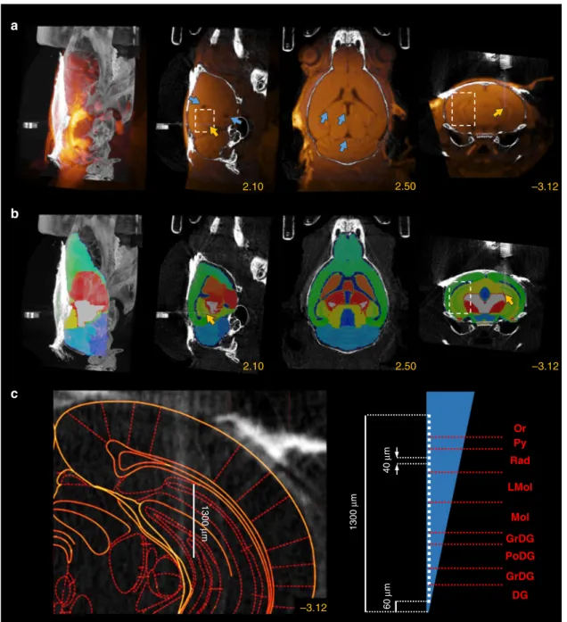 Fig. 5 Localization of hippocampal implants with 3T MRI imaging. a The postoperative CT image co-registered with the high signal-to-noise ratio (SNR) T 1 -weighted preoperative MRI image shows the hippocampus (white dashed box) in addition to the ventricle