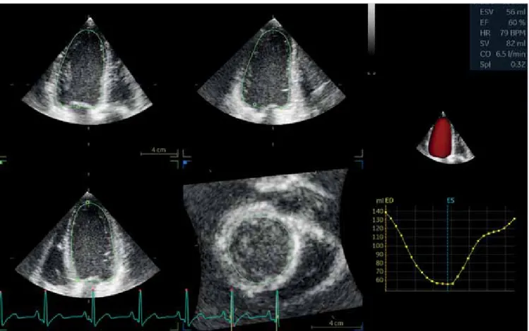 3. ÁBRA. A bal kamra 3D kvantifikációja. A szoftvertől függően lehetőség van szemiautomatikus, illetve teljesen automatikus  endokardiális kontúrozásra