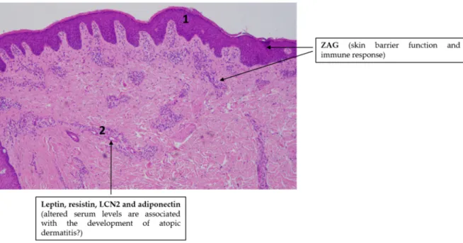 Figure 3. Adipokines might be involved in the pathogenesis of atopic dermatitis. Note the simplified  characteristic  histopathological  findings  in  AD  skin:  slight  epidermal  hyperplasia  with  impaired  barrier function (1) and immune cell infiltrat