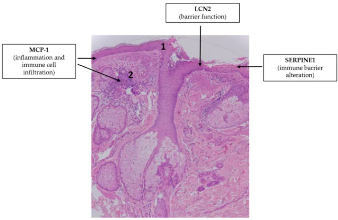 Figure  5.  Adipokines  may  be  involved  in  the  pathogenesis  of  rosacea.  Note  the  simplified  characteristic  histopathological  findings  in  rosacea:  impaired  barrier  function  (1),  interfollicular  inflammation in the dermis (2)
