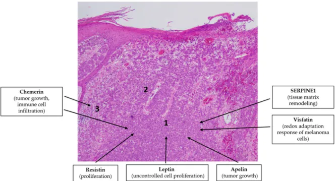 Figure  6.  Adipokines  might  be  involved  in  the  pathogenesis  of  malignant  melanoma