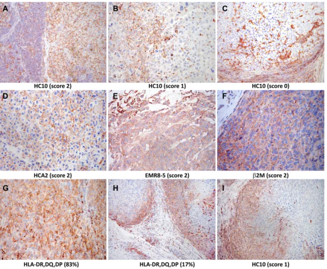 Figure 1  Immunohistochemical staining of melanoma metastases with human leukocyte antigen- specific monoclonal  antibodies (mAbs) (3- amino-9- ethylcarbazole, red)