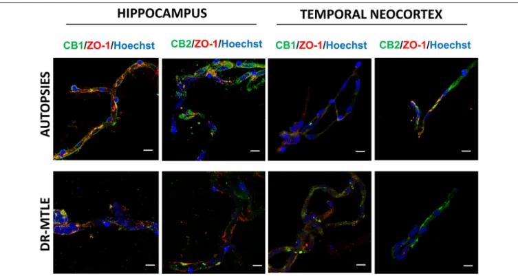 FIGURE 4 | Double-labeling immunofluorescence staining of zonula occludens-1 (ZO-1) and CB1 or CB2 in MECs isolated from the hippocampus and temporal neocortex of non-epileptic autopsies and patients with DR-MTLE