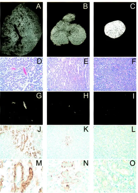 Figure 5  Representative histology and immunohistochemistry from the Dunning  R3327-H prostate adenocarcinoma in rats 