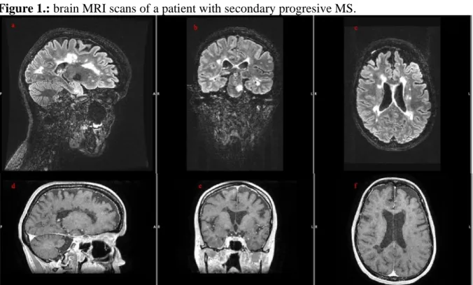 Figure 1.: brain MRI scans of a patient with secondary progresive MS. 