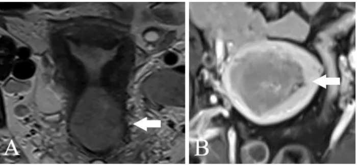 Figure 1. MR imaging. A. Cervical cancer, stromal invasion (T2 sequence) B. Endometrial cancer, myometrial  invasion &gt;50% (T1 sequence) 
