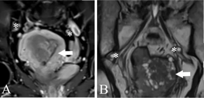 Figure 3 MR imaging. Evaluation of lymph-node metastases. A.: Endometrial cancer, * enlarged lymph-nodes (T2  sequence, phase 3 of gadolinium enhancement)