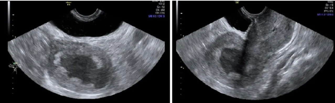 Figure 4. Transvaginal ultrasound. Enlarged uterine cavity with necrotic mass. 2D imaging