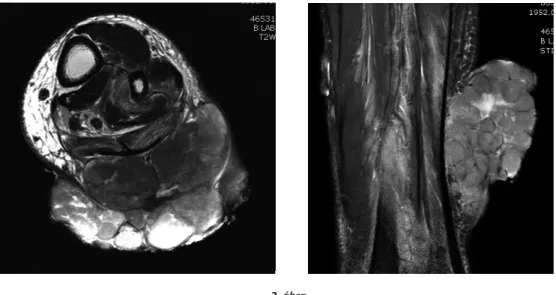 2. ábra     a) T2 súlyozású MRI felvétel  