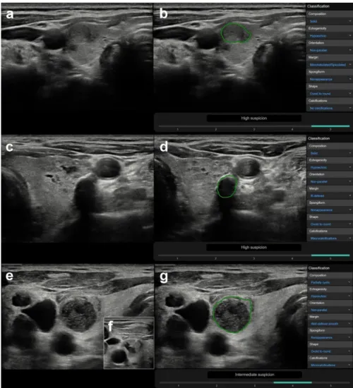 Figure 3. Representative images of CAD system false-positive misdiagnoses of nodules ((a,b) nodule  besides thyroiditis, (c,d) nodule with coarse calcification, (e–g) inspissated colloid cystic nodule)