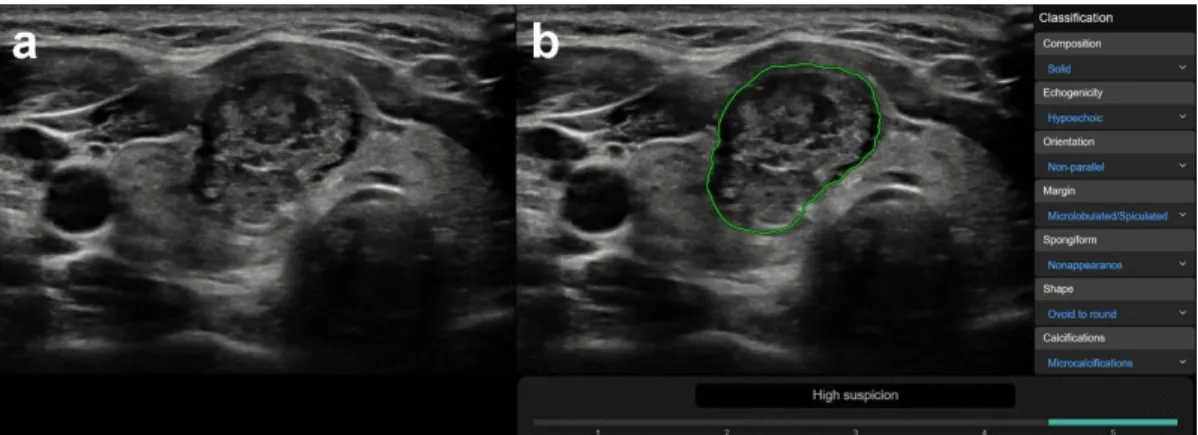 Figure 4. Representative image of a malignant nodule (a), correctly diagnosed by the CAD system (b)