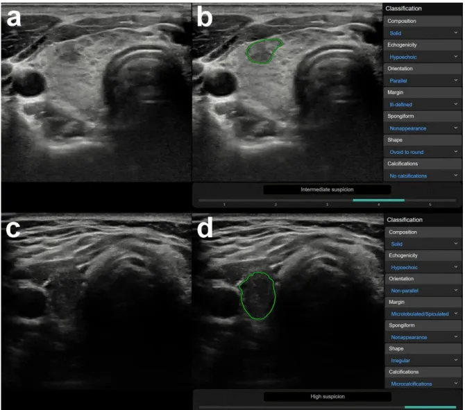 Figure  2.  Representative  images  of  computer-aided  diagnosis  (CAD)  system  false-positive  misdiagnoses of focal inhomogeneities related to thyroiditis