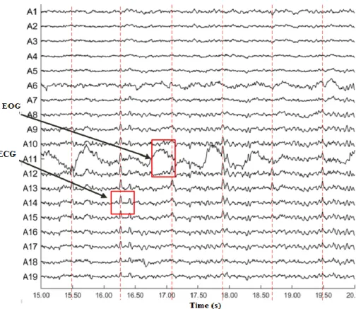 Figure 2-5: EEG raw data contaminated with EOG and ECG artifacts. 