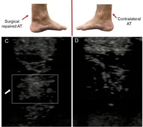 Figure 15 Ultrasonography images in the transverse plane of the (C) AT injured side and (D) AT uninjured side