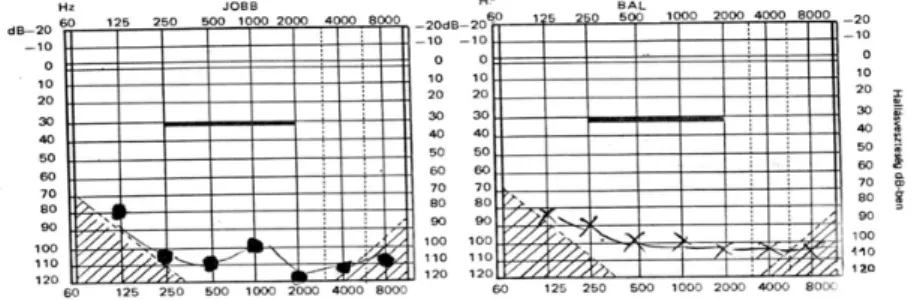3. ábra : Judit audiogramja hallókészülék nélkül Több hallókészüléket is kipróbáltak, a végleges, Widex Senso P 38 típusú készüléket 3 éves korában, 2004