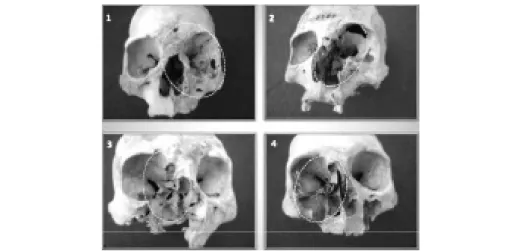 4. ábra. Lutzomya fajok terjesztette kórokozók által elroncsolt prekolumbiánus indián koponyák   Észak-Chiléből (forrás: Costa és munkatársai, 2009; anthropology.net)