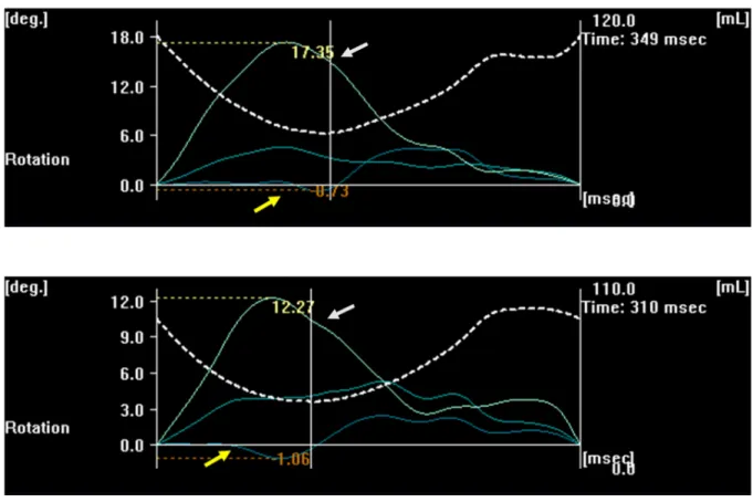 Fig. 4. Increased counterclockwise left ventricular apical rotation (white arrow) with almost zero left ventricular basal rotation (yellow arrow).