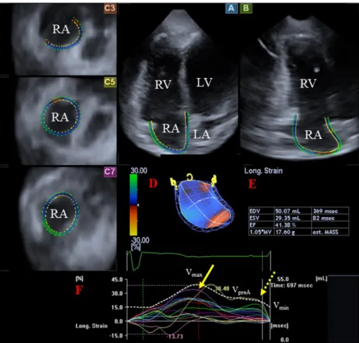 Fig.  1. Three-dimensional  (3D)  speckle-tracking  echocardiographic  right  atrial  (RA)  assessment  using a full-volume dataset in a patient with dextro-  transposition of the great arteries is demonstrated: 