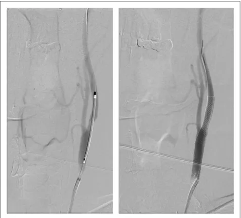 Figure 4 shows the ADC value measurement proce- proce-dure. Extension was determined by the usage of antero-posterior (AP) and latero-lateral (LL)  diame-ters