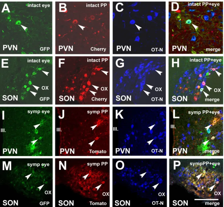 Figure 7. Microphotographs showing OT-N immunoreactivity in double-virus-labeled neurons in the PVN and SON