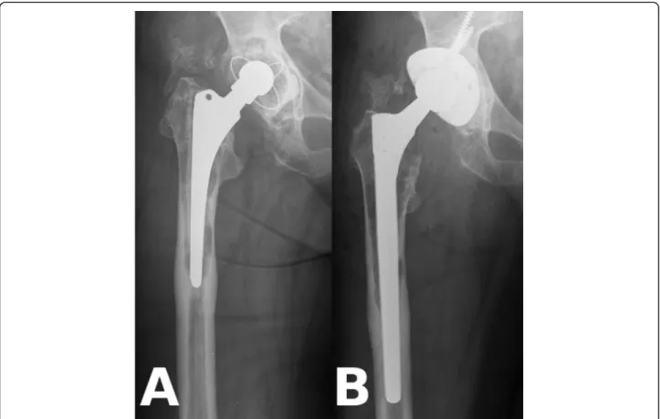 Fig. 1 Example for aseptic loosening of the stem. a: Preoperatively massive, Paprosky 3B type resorption of proximal femoral bone stock around a cemented stem