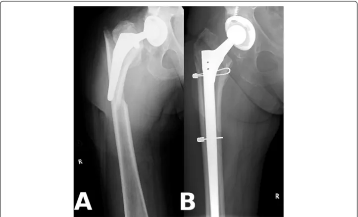 Fig. 2 Example for periprosthetic femur fracture. a: Vancouver B2 type periprosthetic fracture with component loosening around a cementless stem; b: Anatomical reduction with two cables around a Wagner SL stem (Patient 10)