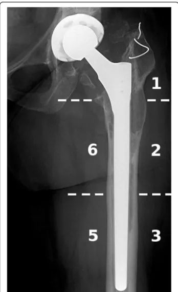 Fig. 3 Example for evaluation of Gruen zones on AP radiograph (Patient 18)