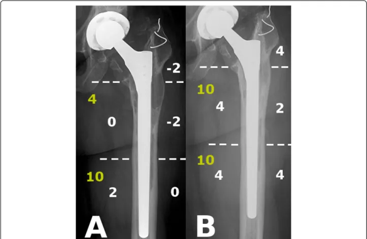 Fig. 4 Example for SBS (white) and O-SS (yellow) measurements in AL group. a: IBS -2, O-SS 14 immediate after the revision, GRxS: 4; b: SBS 18, O-SS 20 at latest follow-up, GRxS: 18 (Patient 18)