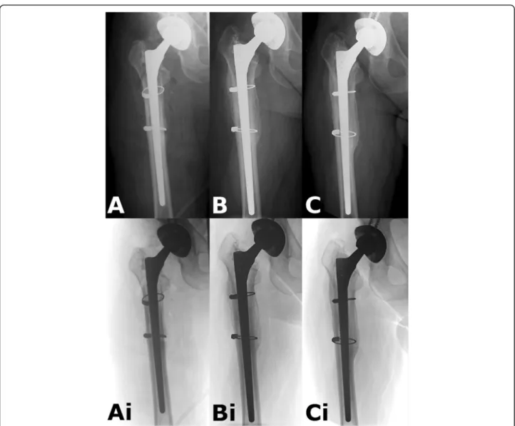 Fig. 6 Example of a PFF case. a: Immediate postop radiograph after revision. The poor quality of the proximal bone stock is unequivocal