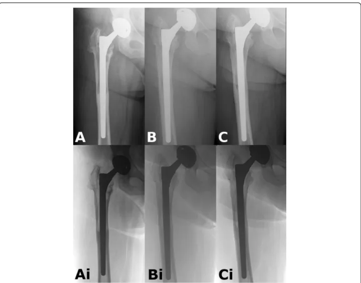Fig. 7 Example for AL case. a: Postoperative radiograph after revision. Obvious proximal femoral lysis