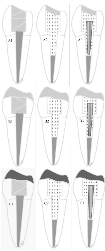 Fig. 1    Diagram showing the  test groups (A1–C3) restored  with different approaches  with various post-core and  overlay restorations