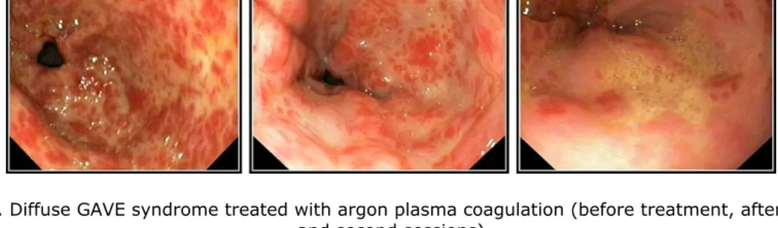 Figure 2. Diffuse GAVE syndrome treated with argon plasma coagulation (before treatment, after the first  and second sessions) 
