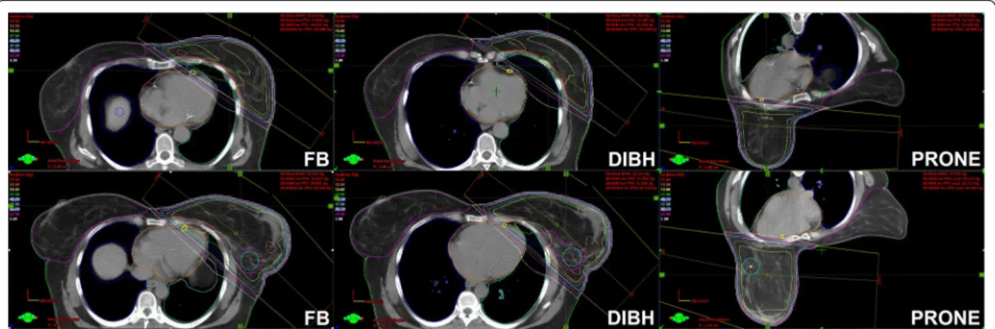 Fig. 1  Three-dimensional conformal whole breast irradiation plans of 2 cases illustrating the benefit (upper series) or the lack of benefit (lower  series) of the DIBH manoeuvre; transversal slices are shown during free-breathing (FB), DIBH and in the pro