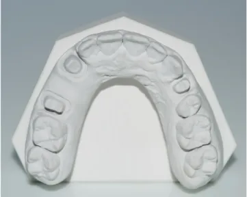Fig. 1. A gypsum model of a dentate maxilla with a prepared tooth (left first  premolar) served as reference for this study