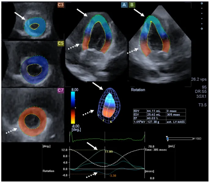 Figure 1 Three-dimensional (3D) speckle-tracking echocardiographic image of a patient with lymphedema