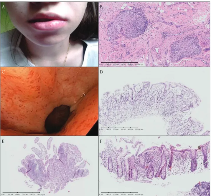 Figure 1. Images from a 20  year-old female, diagnosed initially with OFG age 15  years, then pan-enteric Crohn’s 7  months later