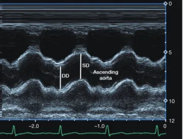 Figure 1 Measurements of systolic (SD) and diastolic (DD)  diameters of the ascending aorta are presented in an M-mode  echocardiographic image obtained 3 cm above the aortic valve