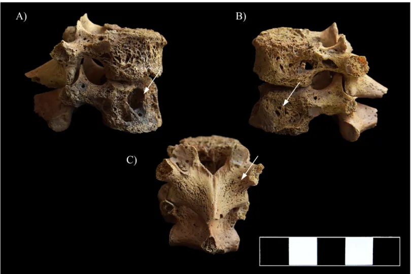 Fig 8. Multiple, well-circumscribed osteolytic lesions, cortical remodeling, and signs of hypervascularization in the T11–12 vertebrae (white arrows)