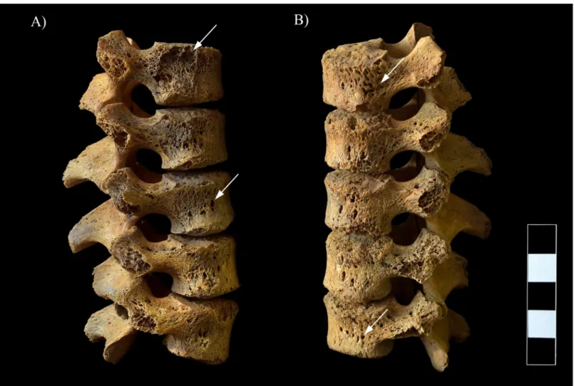 Fig 9. Multiple, well-circumscribed osteolytic lesions, cortical remodeling, and signs of hypervascularization in the L1–5 vertebrae (white arrows)