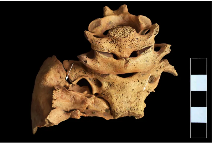 Fig 4. Pitting and slight cortical remodeling on the ectocranial surface of the occipital and left temporal bones (white arrows).