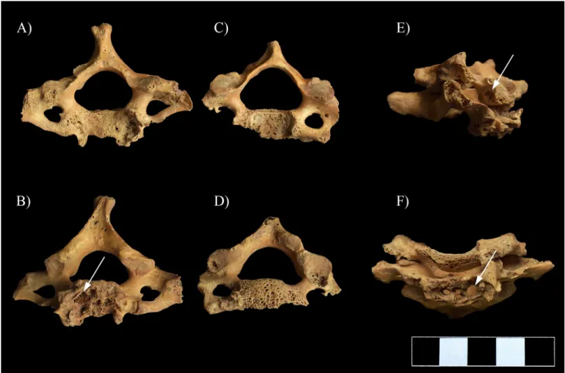 Fig 6. Multiple, well-circumscribed osteolytic lesions (white arrows) and consequent severe bone loss in the C6–7 vertebrae