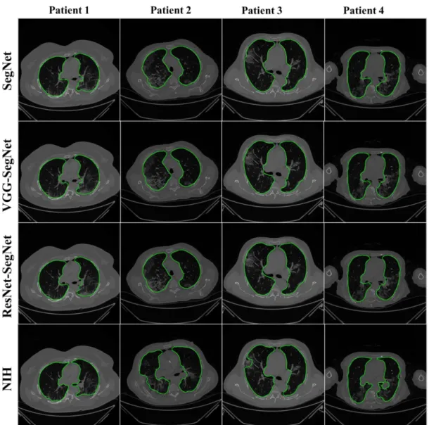 Figure 11. Results from the four AI models and NIH with a grayscale CT slice. Row 1 to Row 4 is four models: SegNet, VGG-SegNet, ResNet-SegNet, and NIH.